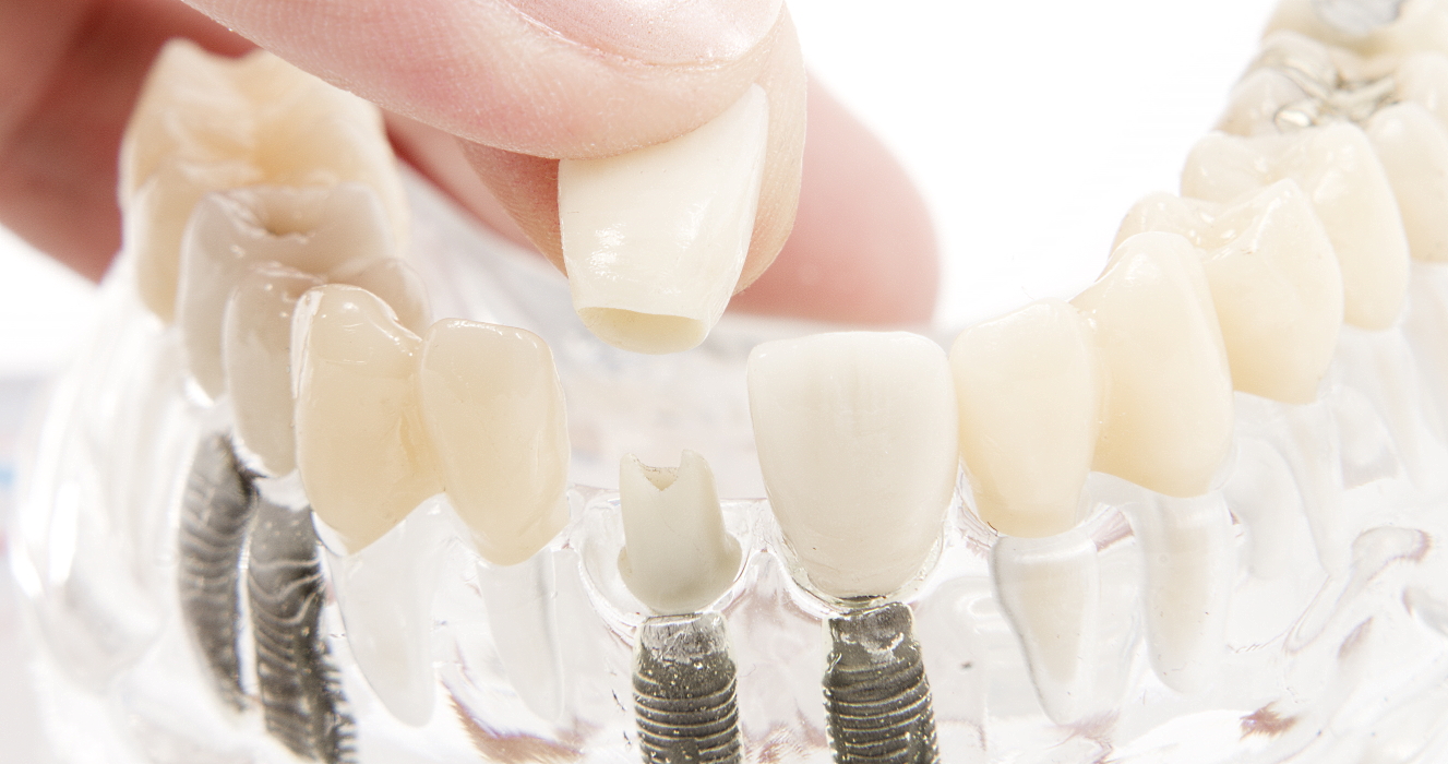 Gebissmodell aus Acryl mit Implantaten